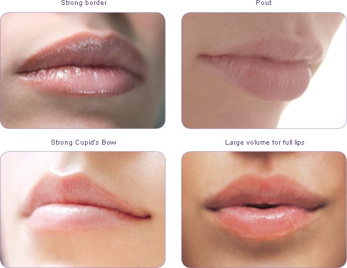 Lip Fillers Lip Enhancement lip augmentation auckland
