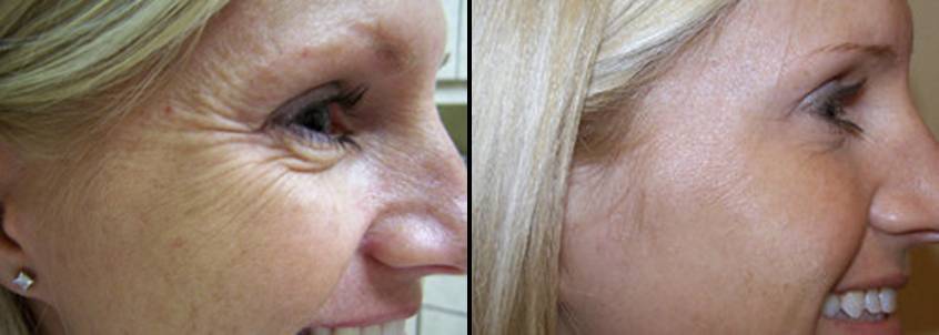 Botox Auckland crows feet