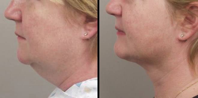 botox auckland nefertiti lift botox facelift
