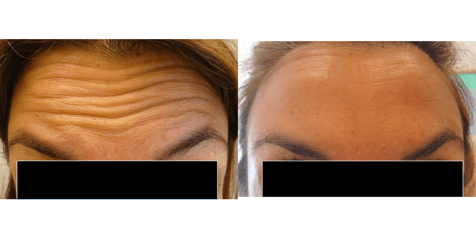 botox auckland - forehead lines
