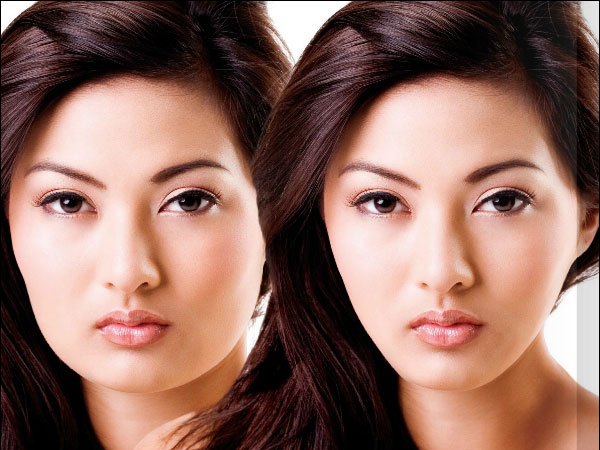 facial shaping botox auckland