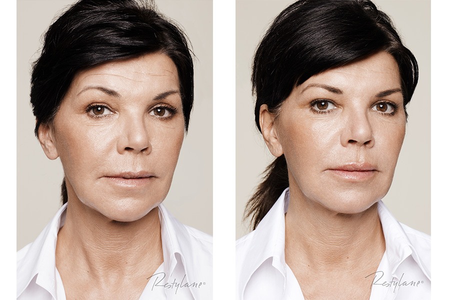 liquid facelift dermal filler facelift auckland