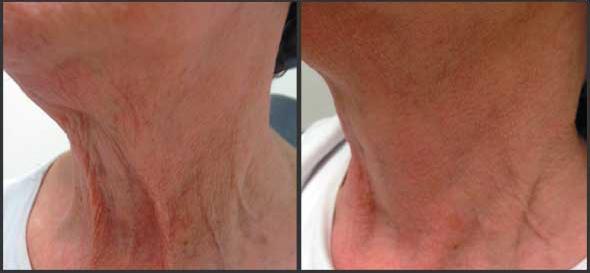 neck rejuvenation auckland