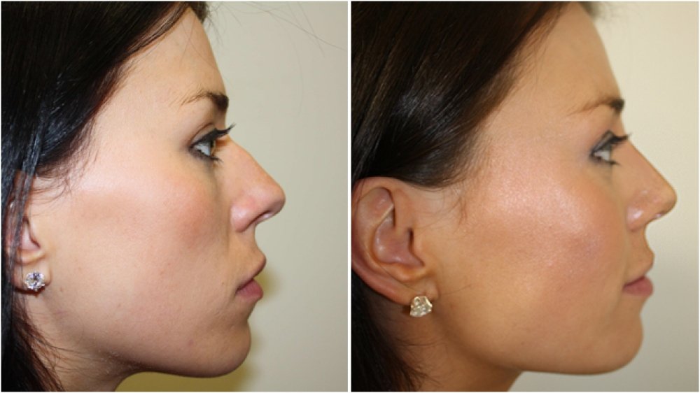 chin implant chin filler