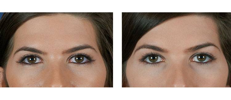 under eye fillers