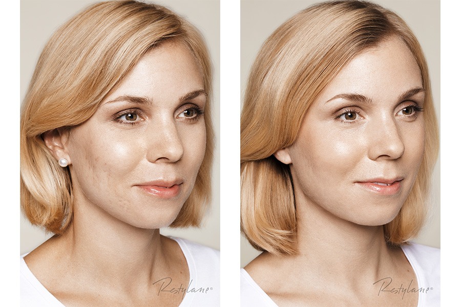 scar reduction auckland