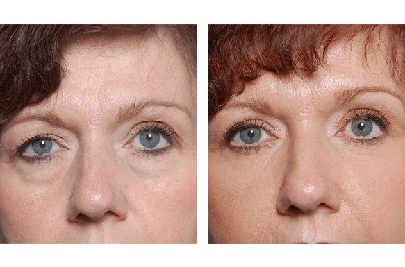 tear trough enhancement