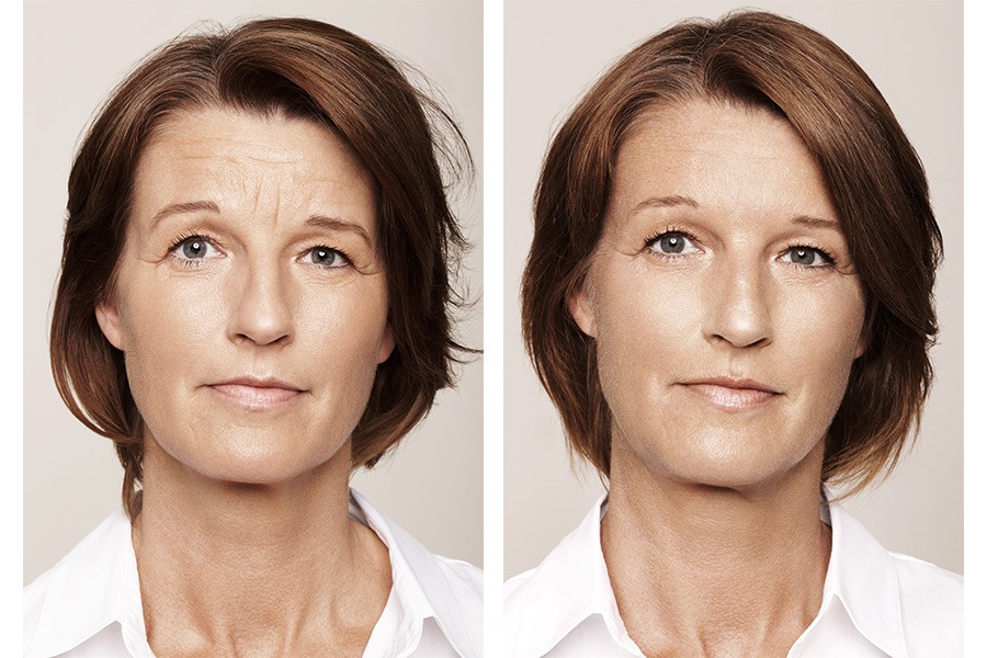 Facial Rejuvenation Auckland