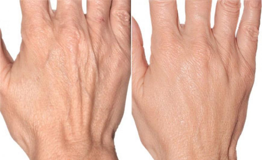 hand rejuvenation auckland